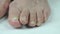 Onychomycosis. Fungal infection of nails of feet