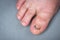 Onychomycosis fungal infection of toenail. Sick nail on the foot after damaging with tight shoes.