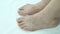 Onychomycosis with fungal nail infection