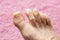 onychomycosis, the initial stage of ringworm. Big toe infected with fungal bacteria, Background pacific pink