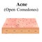 Open comedones. Acne on the skin. Dermatological and cosmetic diseases on the skin of the face acne. Infographics