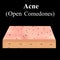 Open comedones. Acne on the skin. Dermatological and cosmetic diseases on the skin of the face acne. Infographics