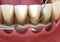 Open curettage: Scaling and root planing conventional periodontal therapy. Medically accurate 3D illustration of human teeth