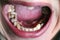 Open mouth with broken, diseased teeth affected by caries and periodontitis. Steel pin in the gum for the installation of a dental
