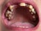 Open mouth with broken, diseased teeth affected by caries and periodontitis. Steel pin in the gum for the installation of a dental