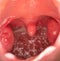 Open mouth view of tonsils