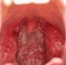 Open mouth view of tonsils