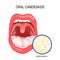 Oral candidiasis. yeast infection ofl Candida albicans the mouth