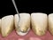 Oral hygiene: Scaling and root planing conventional periodontal therapy. Medically accurate 3D illustration