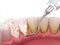 Oral hygiene: Scaling and root planing conventional periodontal therapy. Medically accurate 3D illustration of human teeth
