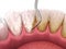 Oral hygiene: Scaling and root planing conventional periodontal therapy. Medically accurate 3D illustration of human teeth