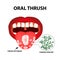 Oral thrush. Candidiasis on the tongue. Fungus in the mouth. Infographics. Vector illustration on isolated background.
