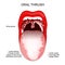 Oral thrush. A white coating on the tongue and White patches in throat