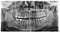 Original black white x-ray teeth scan mandible