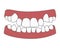 Orthodontic problem teeth crowding. Abnormal eruption