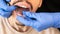 Orthodontic specialist adjusting invisible aligners on man with mustache