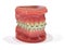 Orthodontic teeth models dental education model jaws with half ceramic and half metal bracket Teeth and Jaw Models