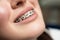 Orthodontic Treatment. Dental Care Concept. Beautiful Woman Healthy Smile close up. Closeup Ceramic and Metal Brackets