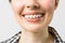 Orthodontic Treatment. Dental Care Concept. Beautiful Woman Healthy Smile close up. Closeup Ceramic and Metal Brackets