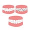 Orthodontic treatment of malocclusion of the teeth braces.