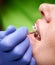 Orthodontist hands placing braces on woman teeth.