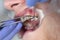 An orthodontist installs braces on the upper dentition of an adult patient. Correction of malocclusion or uneven dentition in a