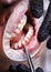 Orthodontist placing bracket system on patient teeth.