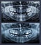 Orthopantomograph panoramic image radiograph of teeth
