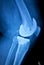 Orthopedic knee implant Xray scan