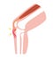 Osgood-schlatter disease / Knee joint section illustration  / no text