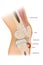 Osgood Schlatter disease or OSD is inflammation of the patellar ligament at the tibial tuberosity