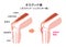 Osgood-schlatter disease vector illustration / Japanese