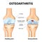 Osteoarthritis or arthritis