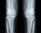 Osteoarthritis both knee . film x-ray AP anterior - posterior of knee show narrow joint space , osteophyte spur , subcond