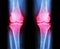 Osteoarthritis both knee . film x-ray AP ( anterior - posterior ) of knee show narrow joint space , osteophyte ( spur ) , subcond