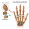 Osteoarthritis of the hand