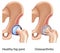 Osteoarthritis of hip joint