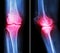 Osteoarthritis knee