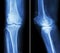 Osteoarthritis knee . film x-ray knee ( anterior - posterior and lateral view ) show narrow joint space , osteophyte ( spur ) ,