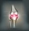 Osteoarthritis knee joint destruction