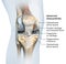 Osteoarthritis of the knee joint, medical illustration