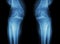 Osteoarthritis Knee ( OA Knee ) ( Film x-ray both knee with arthritis of knee joint : narrow knee joint space ) ( Medical and