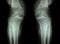 Osteoarthritis Knee ( OA Knee ) ( Film x-ray both knee with arthritis of knee joint : narrow knee joint space ) ( Medical and