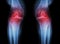 Osteoarthritis Knee ( OA Knee ) ( Film x-ray both knee with arthritis of knee joint : narrow knee joint space ) ( Medical and