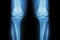 Osteoarthritis Knee ( OA Knee ). Film x-ray both knee ( front view ) show narrow joint space ( joint cartilage loss ) , osteophyte