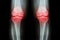 Osteoarthritis Knee ( OA Knee ). Film x-ray both knee ( front view ) show narrow joint space ( joint cartilage loss ) , osteophyte