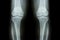 Osteoarthritis Knee ( OA Knee ). Film x-ray both knee ( front view ) show narrow joint space ( joint cartilage loss ) , osteophyte