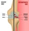 Osteoarthritis Knee Poster