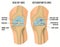 Osteoarthritis Knee Poster