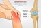 Osteoarthritis Knee Poster